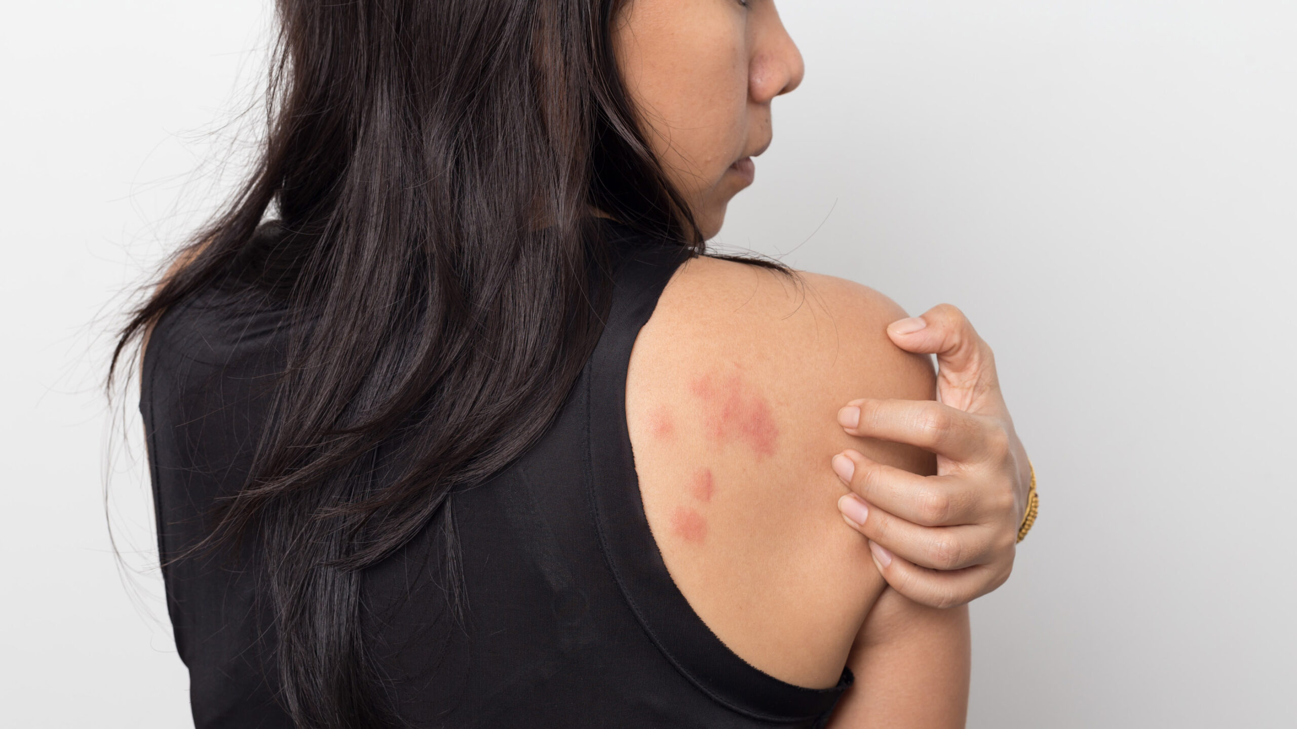 Can the coronavirus disease live on my skin?