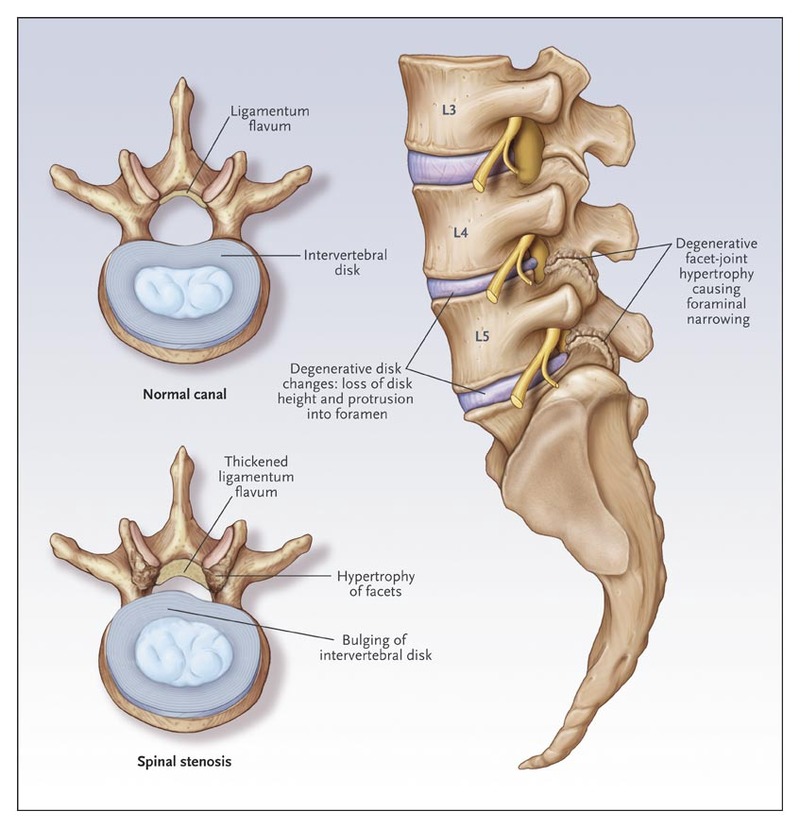 What is lumbosacral spinal stenosis?